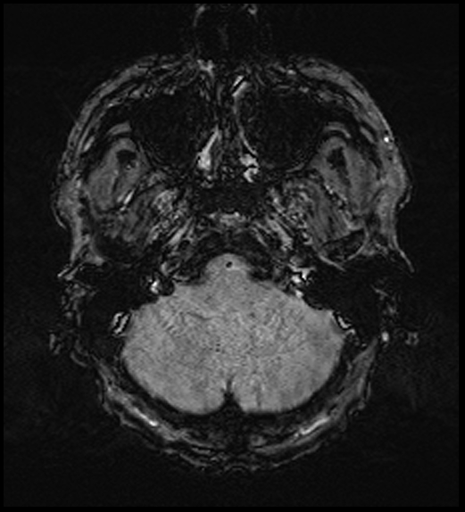 Cerebral abscess with ventriculitis (Radiopaedia 78965-91878 Axial SWI 11).jpg
