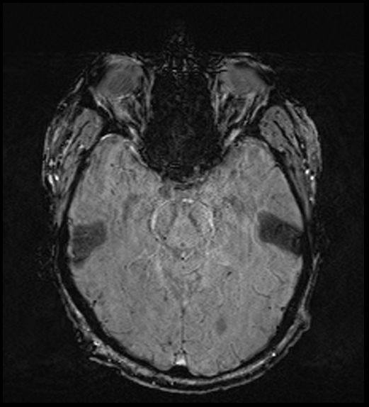 Cerebral abscess with ventriculitis (Radiopaedia 78965-91878 Axial SWI 22).jpg