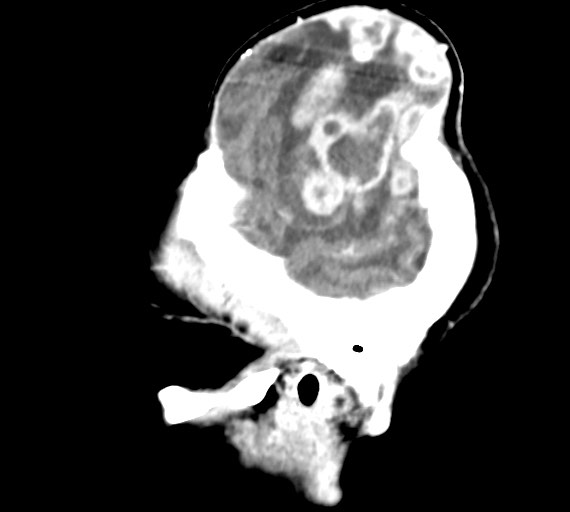 Cerebral abscesses (Radiopaedia 70458-80568 Sagittal Contrast 9).jpg