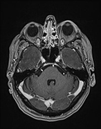 Cerebral amyloid angiopathy-related inflammation (Radiopaedia 58270-65377 Axial T1 C+ fat sat 33).jpg
