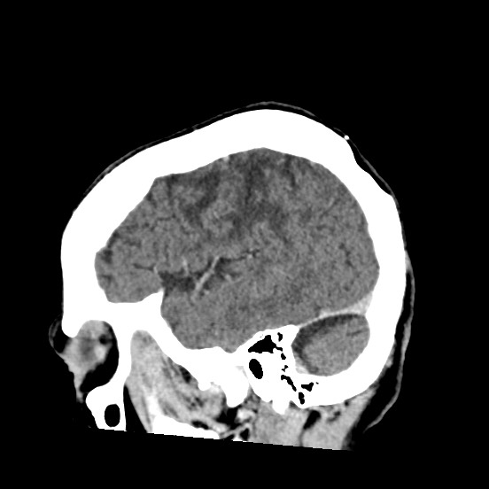 Cerebral amyloid angiopathy-related inflammation (Radiopaedia 74836-85848 C 13).jpg