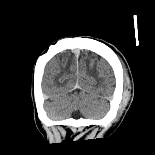 Cerebral amyloid angiopathy-related inflammation (Radiopaedia 74836-85848 Coronal non-contrast 60).jpg