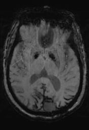 File:Cerebral amyloid angiopathy (Radiopaedia 29129-29518 Axial SWI MPR 18).jpg