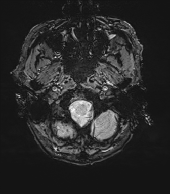 File:Cerebral amyloid angiopathy (Radiopaedia 46082-50433 Axial SWI 6).png