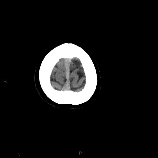 File:Cerebral amyloid angiopathy (Radiopaedia 77506-89665 Axial non-contrast 105).jpg