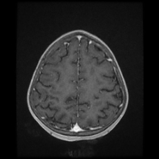 File:Cerebral and spinal tuberculosis (Radiopaedia 90489-107837 Axial T1 C+ 152).jpg
