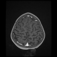 Cerebral and spinal tuberculosis (Radiopaedia 90489-107837 Axial T1 C+ 160).jpg