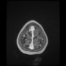 Cerebral and spinal tuberculosis (Radiopaedia 90489-107837 Axial T1 C+ 176).jpg