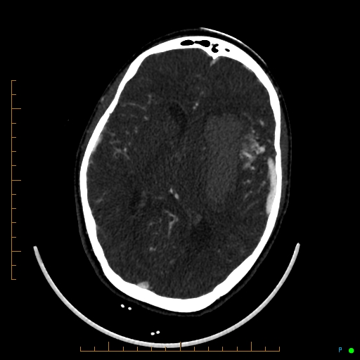 Cerebral arteriovenous malformation (AVM) (Radiopaedia 78162-90706 Axial CTA 149).jpg