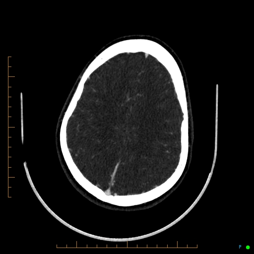 Cerebral arteriovenous malformation (AVM) (Radiopaedia 78162-90706 Axial CTA 207).jpg