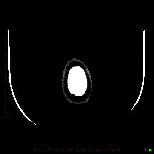 Cerebral arteriovenous malformation (AVM) (Radiopaedia 78162-90706 Axial non-contrast 65).jpg