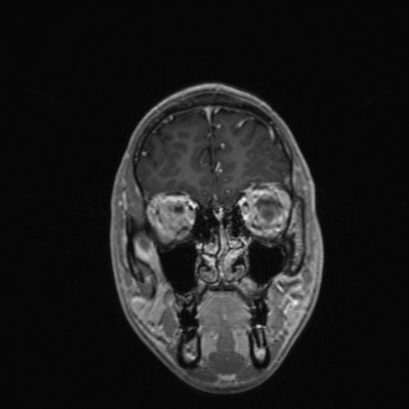 Cerebral arteriovenous malformation (Radiopaedia 30198-30813 F 14).jpg