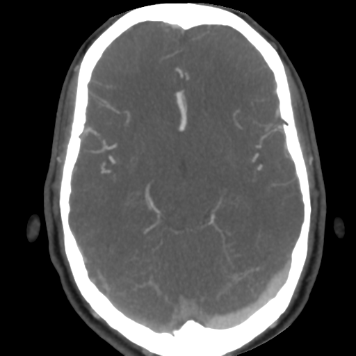 Cerebral arteriovenous malformation (Radiopaedia 39259-41505 AX CEREBRAL CTA 25).png