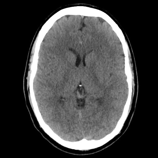 File:Cerebral arteriovenous malformation (Radiopaedia 39259-41505 Brain Ax 5mm 14).png