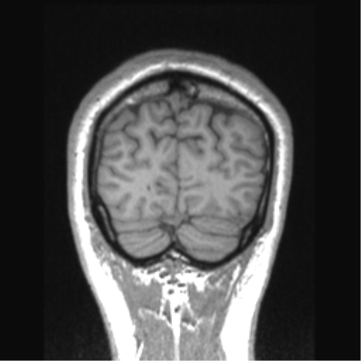 Cerebral arteriovenous malformation (Radiopaedia 39259-41506 Coronal T1 15).png