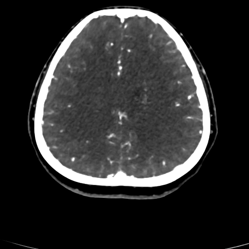 Cerebral arteriovenous malformation (Radiopaedia 73830-84645 Axial C+ delayed 28).jpg