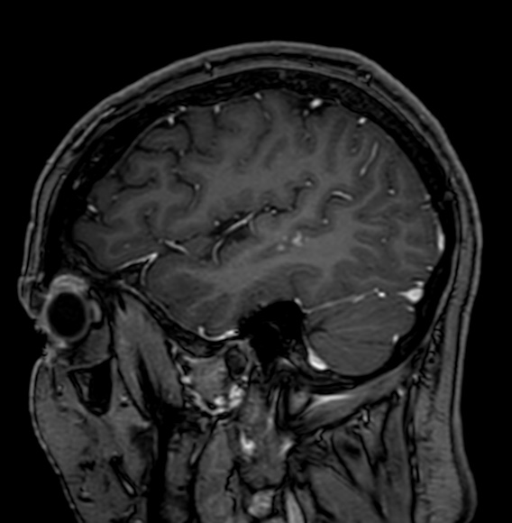 Cerebral arteriovenous malformation (Radiopaedia 74411-85746 Sagittal T1 C+ 23).jpg