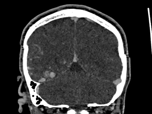 Cerebral arteriovenous malformation (Radiopaedia 78188-90746 Coronal C+ delayed 93).jpg