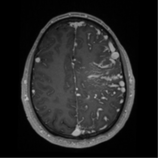 Cerebral arteriovenous malformation - huge (Radiopaedia 35734-37272 Axial T1 C+ 53).png