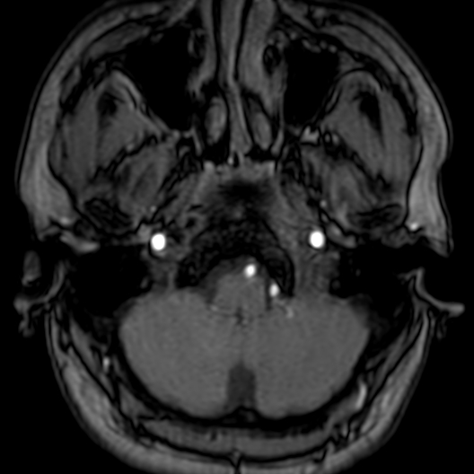 Cerebral arteriovenous malformation at posterior body of corpus callosum (Radiopaedia 74111-84925 Axial MRA 18).jpg