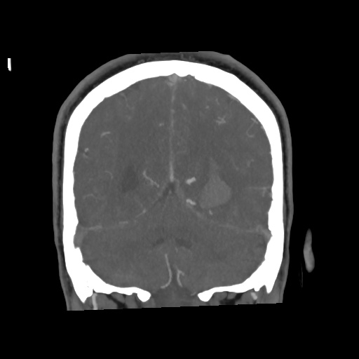 Cerebral arteriovenous malformation with lobar hemorrhage (Radiopaedia 35598-57216 C 69).jpg