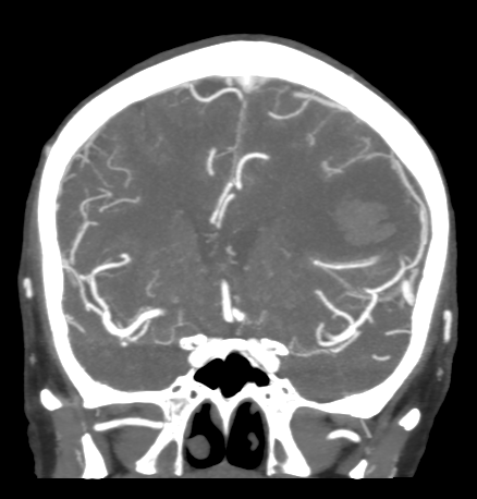 Cerebral arteriovenous malformation with lobar hemorrhage (Radiopaedia 44725-48511 B 23).png