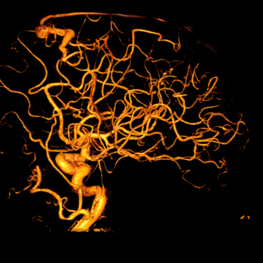 Cerebral arteriovenous malformation with lobar hemorrhage (Radiopaedia 44725-48513 Lateral 32).png