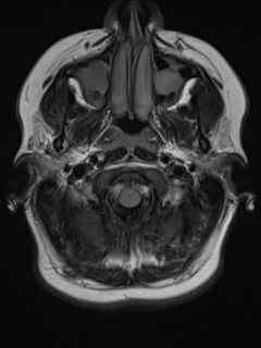 File:Cerebral cavernoma and development venous anomaly (Radiopaedia 37603-39482 Axial FLAIR 2).png