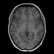 File:Cerebral cavernous venous malformation (Radiopaedia 70008-80021 Axial T1 35).jpg