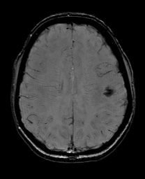 Cerebral cavernous venous malformation (Radiopaedia 70008-80021 I 50).jpg