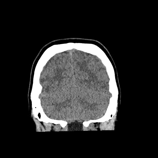 Cerebral cavernous venous malformation (Radiopaedia 70008-80022 non-contrast 58).jpg