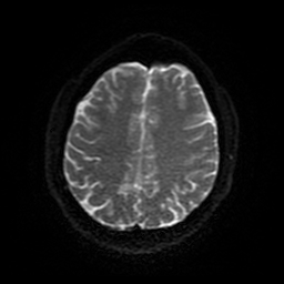 Cerebral cavernous venous malformation (Zabramski type II) (Radiopaedia 85511-101198 Axial DWI 89).jpg