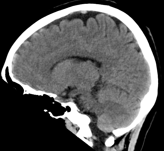 File:Cerebral cavernous venous malformations (Radiopaedia 48117-52945 C 15).png