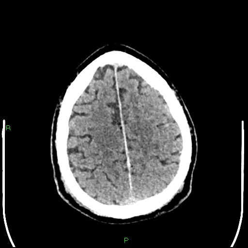 Cerebral contusions (Radiopaedia 33868-35039 Axial non-contrast 174).jpg