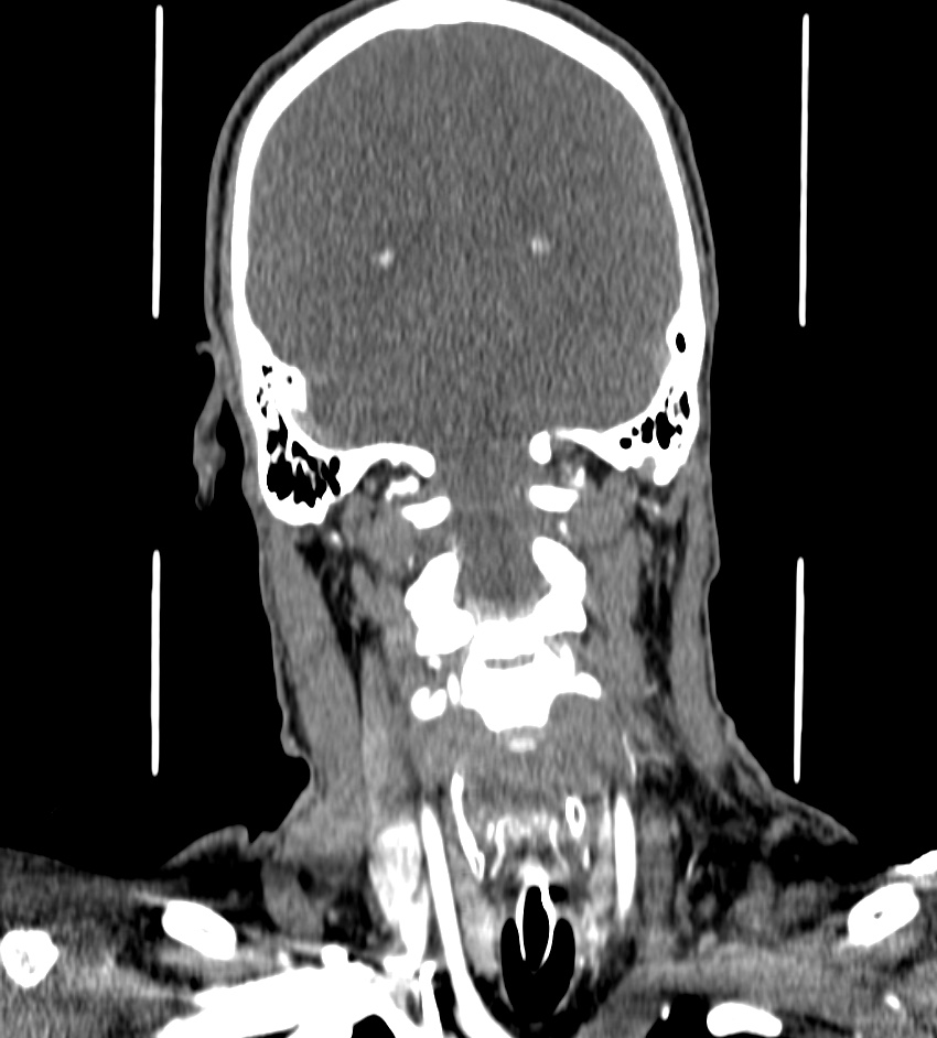 Cerebral edema in an overdose patient (Radiopaedia 72005-82539 B 106).jpg
