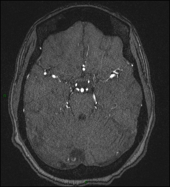 Cerebral fat embolism (Radiopaedia 35022-36525 Axial TOF 73).jpg