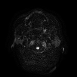 Cerebral metastases - melanoma (Radiopaedia 80972-94522 Axial DWI 33).jpg