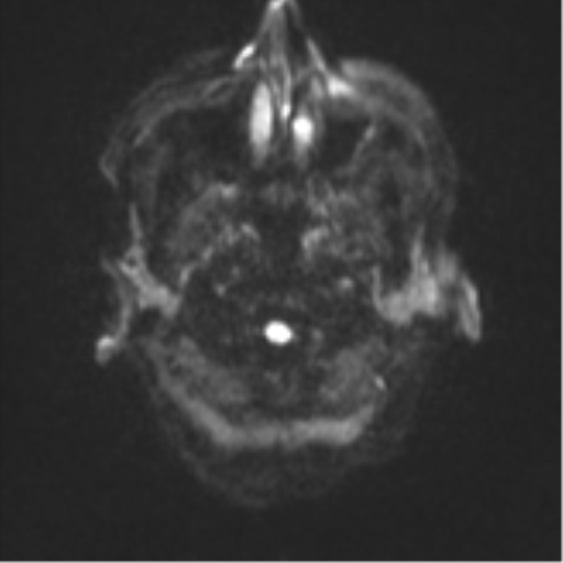 Cerebral metastasis (Radiopaedia 46744-51248 Axial DWI 29).png
