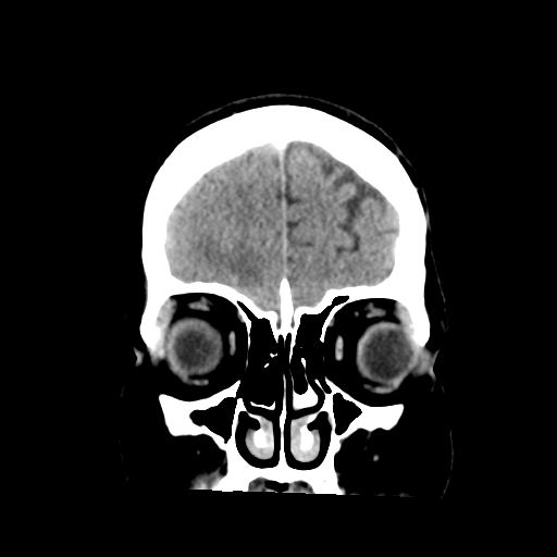 Cerebral metastasis to basal ganglia (Radiopaedia 81568-95412 Coronal C+ delayed 12).png