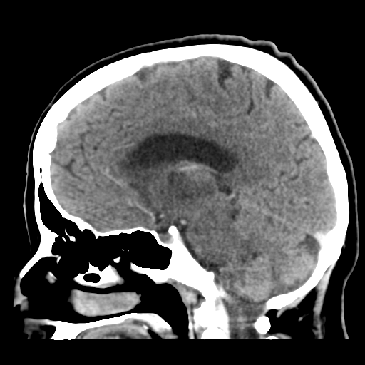 Cerebral metastasis to basal ganglia (Radiopaedia 81568-95412 Sagittal C+ delayed 32).png