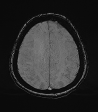 Cerebral metastasis to basal ganglia (Radiopaedia 81568-95413 Axial SWI 66).png
