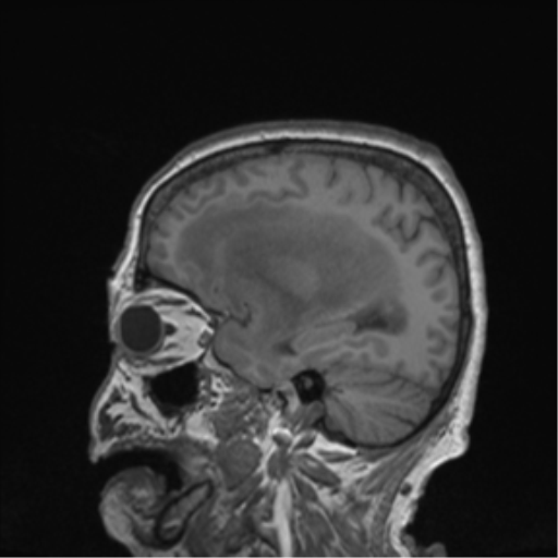 Cerebral metastasis to basal ganglia (Radiopaedia 81568-95413 Sagittal T1 55).png