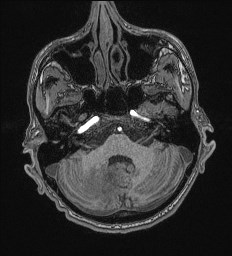 File:Cerebral toxoplasmosis (Radiopaedia 43956-47461 Axial T1 16).jpg