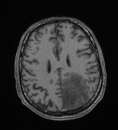 Cerebral toxoplasmosis (Radiopaedia 43956-47461 Axial T1 54).jpg