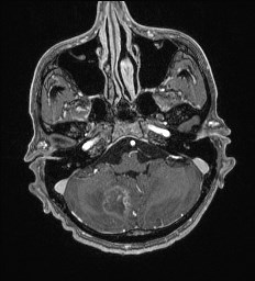 Cerebral toxoplasmosis (Radiopaedia 43956-47461 Axial T1 C+ 12).jpg