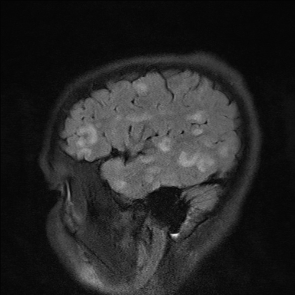 File:Cerebral toxoplasmosis (Radiopaedia 53993-60132 Sagittal FLAIR 23).jpg