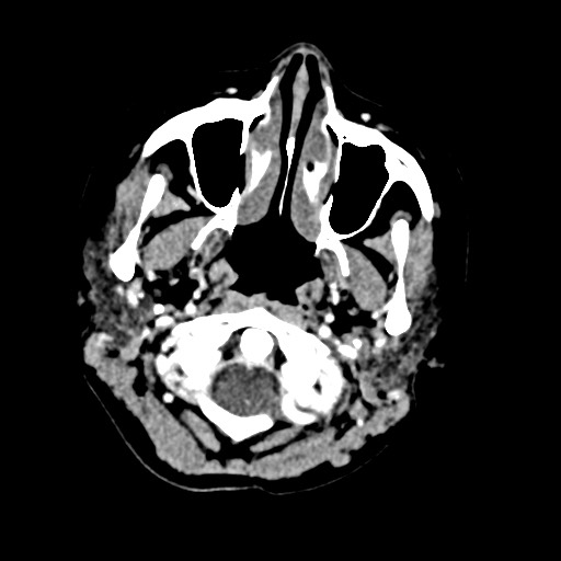 Cerebral tuberculosis with dural sinus invasion (Radiopaedia 60353-68019 Axial C+ delayed 1).jpg