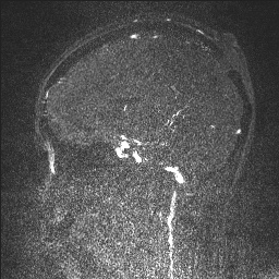 Cerebral tuberculosis with dural sinus invasion (Radiopaedia 60353-68090 Sagittal MRV 85).jpg