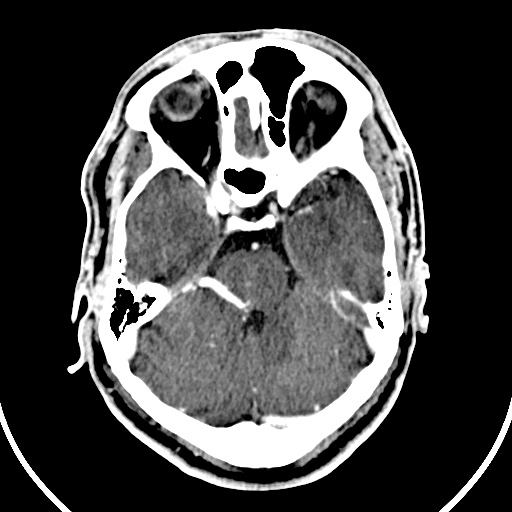 File:Cerebral venous angioma (Radiopaedia 69959-79977 B 19).jpg