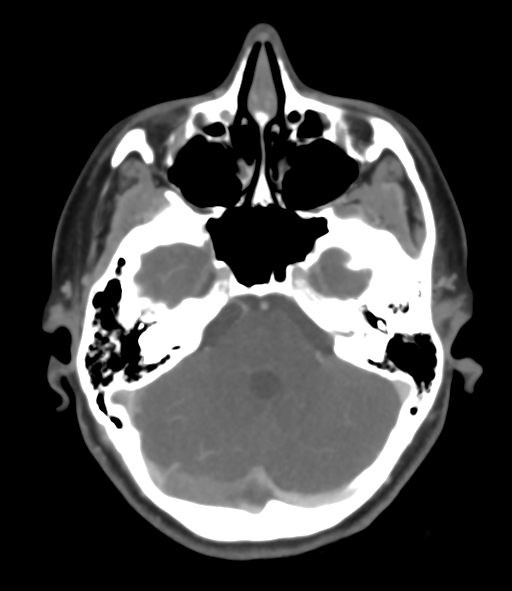 File:Cerebral venous hemorrhagic infarction (Radiopaedia 38461-40550 Axial MIP VENOGRAM 15).png